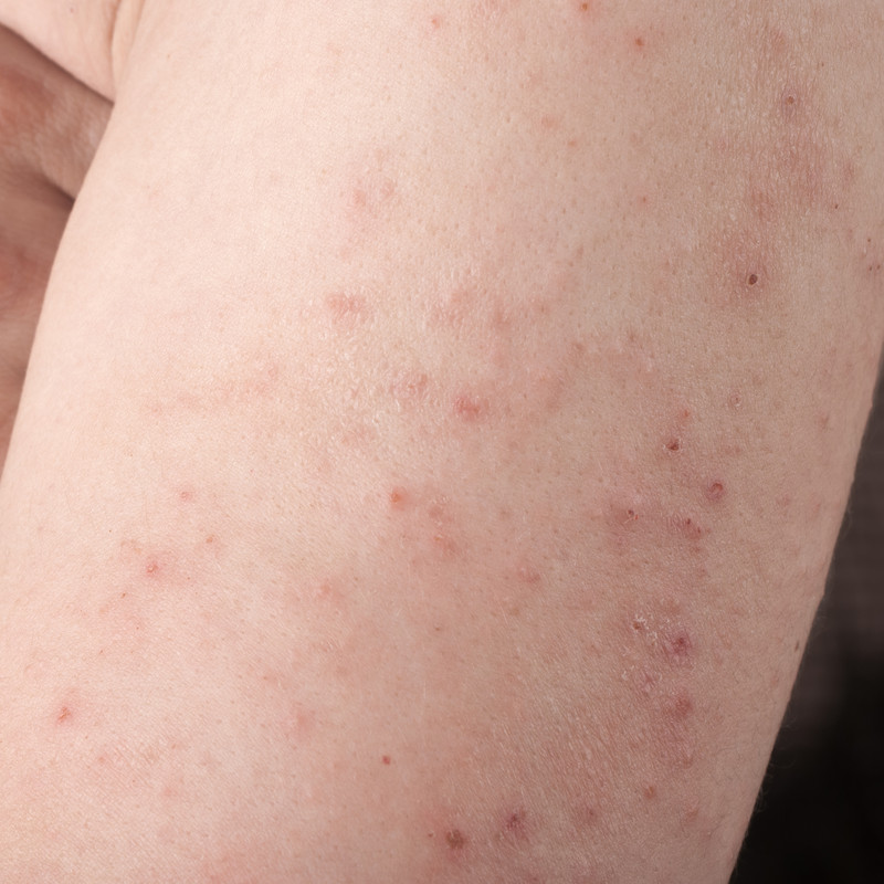 Dermatitis Herpetiformis:an itchy, burning, blistering rash!