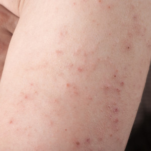 Picture of an arm with a dermatitis herpetiformis rash