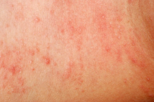 Skin with a dermatitis herpetiformis rash